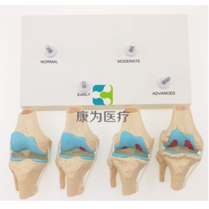 “康為醫(yī)療”四階段病變膝關(guān)節(jié)模型，4階段膝關(guān)節(jié)模型