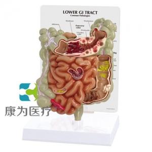 “康為醫(yī)療”醫(yī)患關(guān)系溝通模型-病理大、小腸模型（醫(yī)學(xué)指導(dǎo)模型）