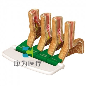 “康為醫(yī)療”醫(yī)患關(guān)系溝通模型-胃食管反流?。℅ERD）模型 （醫(yī)學(xué)指導(dǎo)模型）