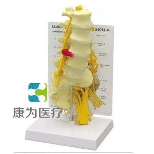 “康為醫(yī)療”醫(yī)患關(guān)系溝通模型-骶骨附腰神經(jīng)、右側(cè)骶骨神經(jīng)和坐骨神經(jīng)模型 （醫(yī)學(xué)指導(dǎo)模型）
