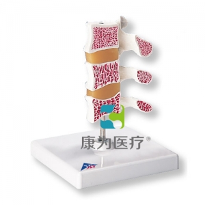 豪華型骨質(zhì)疏松癥模型，3塊椎骨