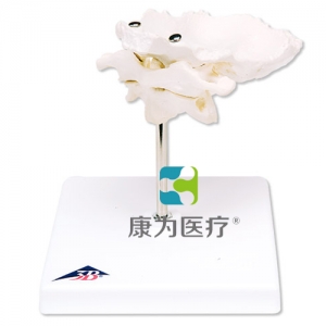 帶有枕骨片的環(huán)椎和樞椎組合，置于可拆卸基架