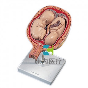 第五個(gè)月雙胞，正常位置
