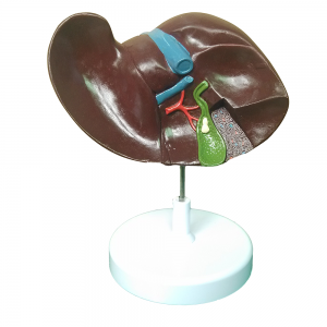 肝和膽結石模型