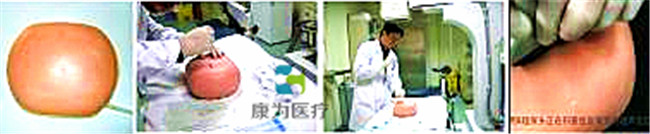 高仿真超聲、X線引導經(jīng)皮穿刺腎鏡訓練模型