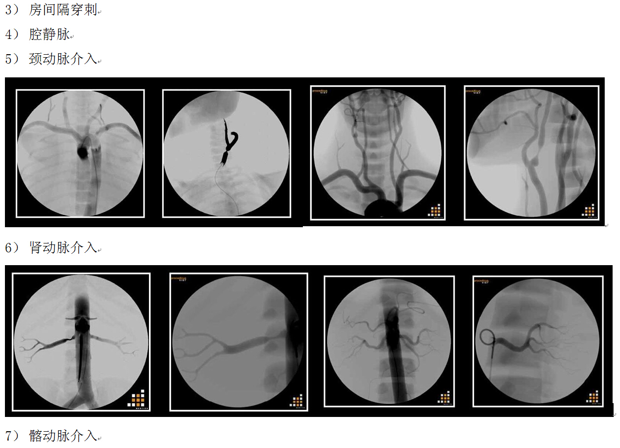 血管介入手術(shù)模擬器，Mentice