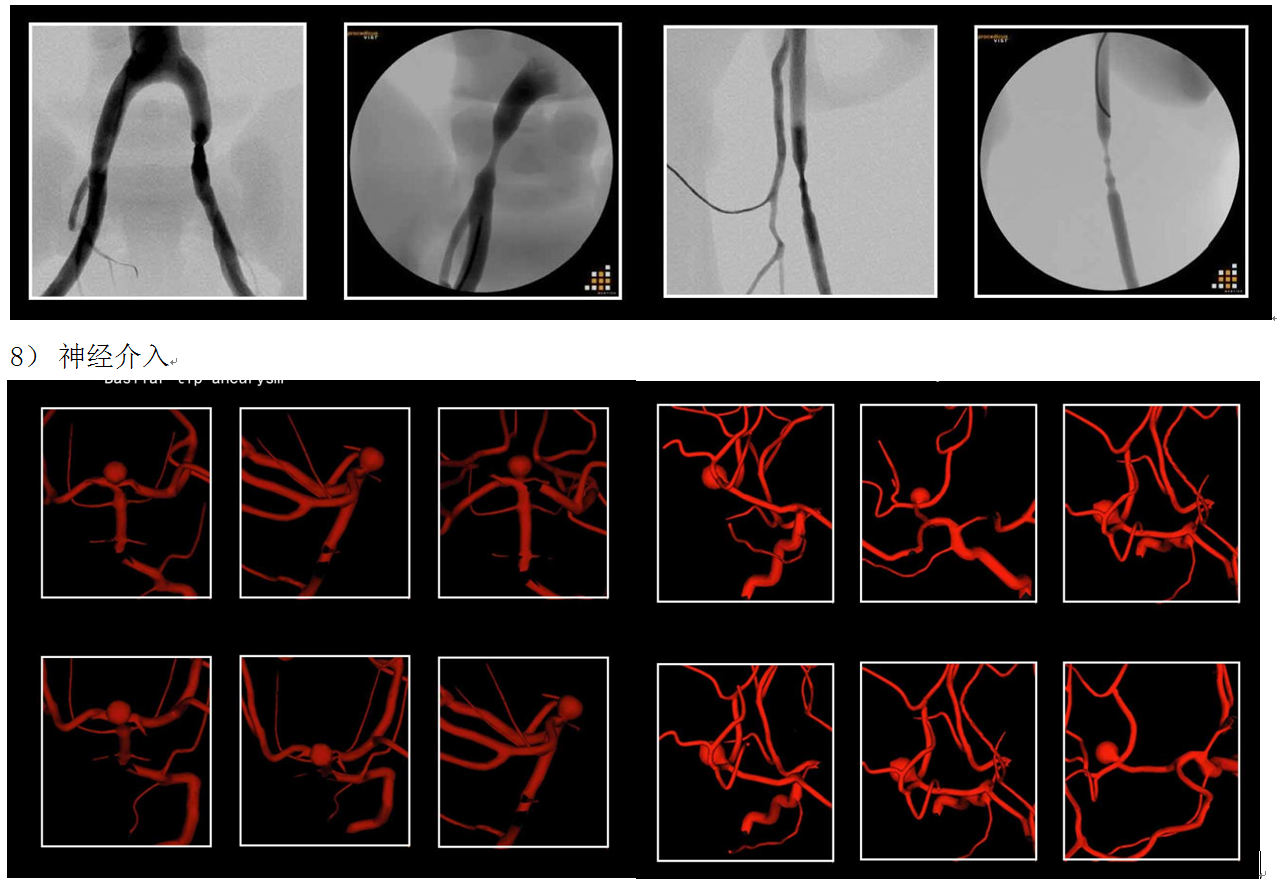 血管介入手術(shù)模擬器，Mentice