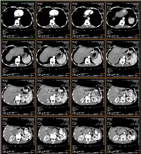 肺癌CT篩查模型